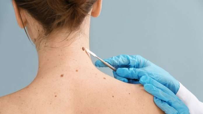 Aumentan en el mundo casos de cáncer de piel en los jóvenes
